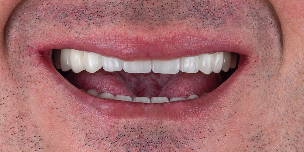 All on Six Dental Implant