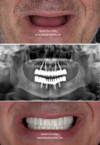 Dental Implant Turkey