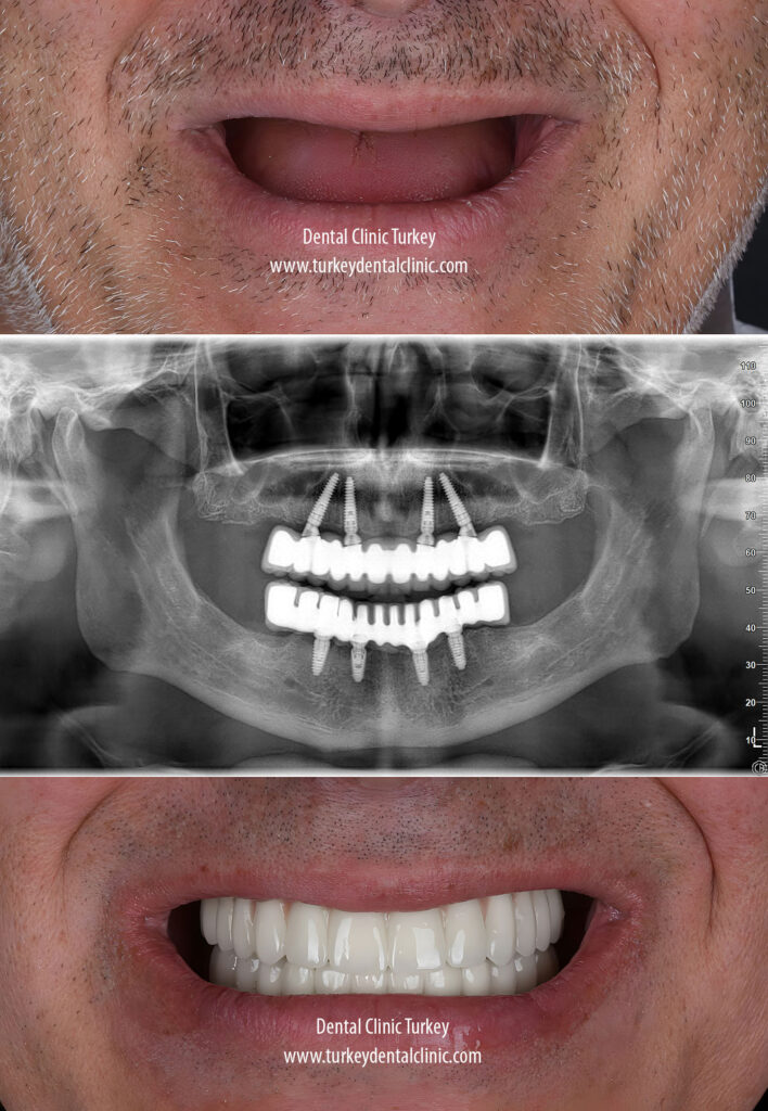 Dental Implant Turkey