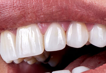 Couronnes en zirconium en Turquie