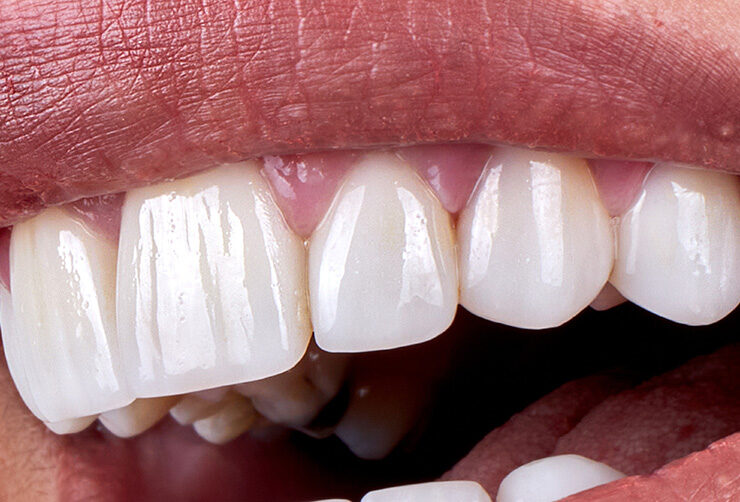 Couronnes en zirconium en Turquie