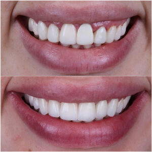 Couronne Dentaire en Turquie 1