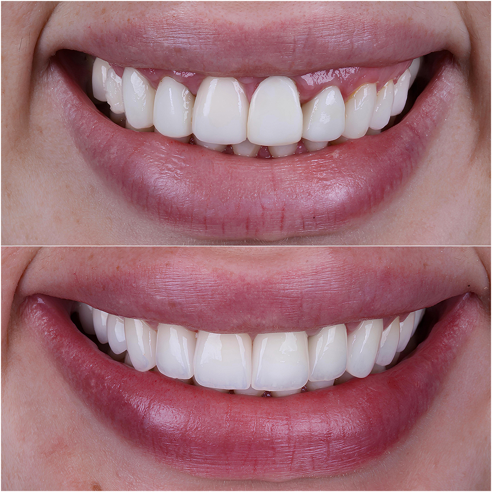 Dental Crowns Turkey in Antalya