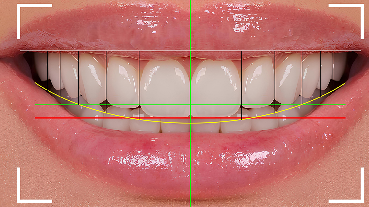 Dental Crowns Turkey