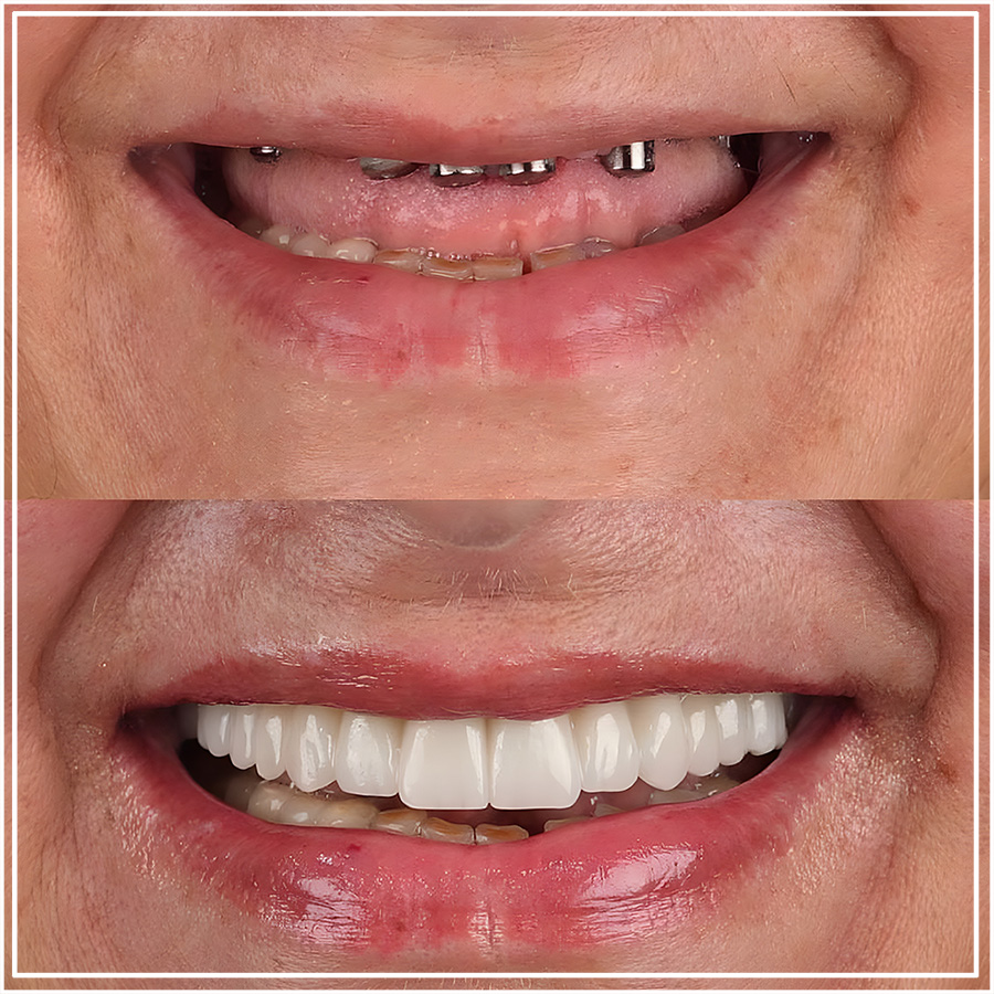 Resultado de implantes dentales en Turkey Dental Clinic