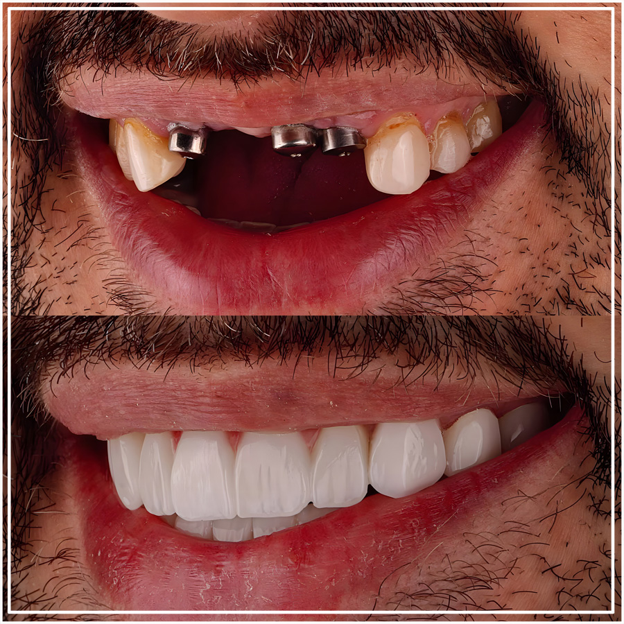 Implantes dentales antes y después en Turquía