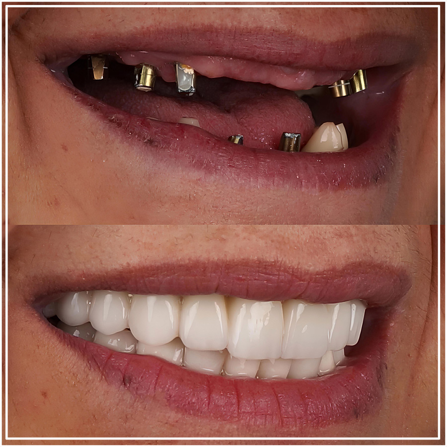 Resultado de implantes All-on-4