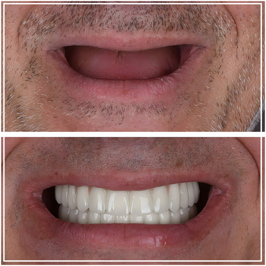 Resultado de implantes All-on-6