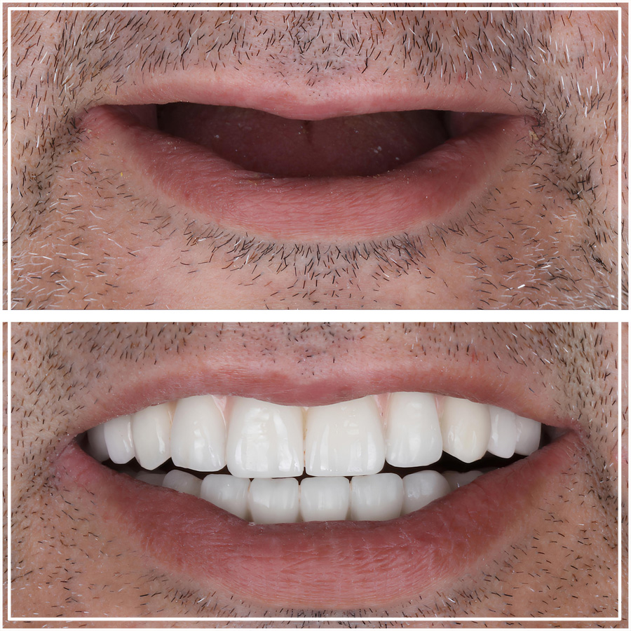Cambio de sonrisa con implantes en toda la arcada