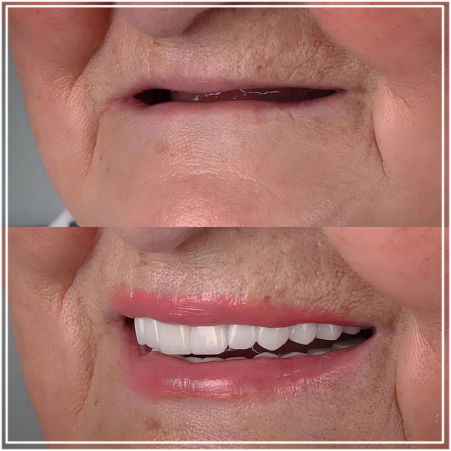 Dientes fijos sobre implantes en Antalya, Turquía