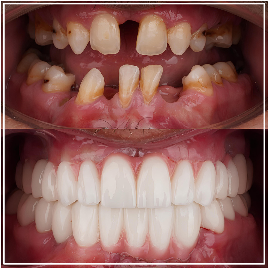 Sonrisa de un paciente con implantes