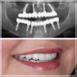 All on 4 and All on 6 Dental Implants