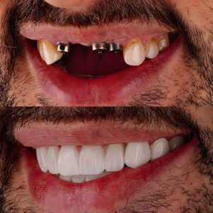 dental implants front teeth