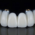 Full arch dental implant prothesis