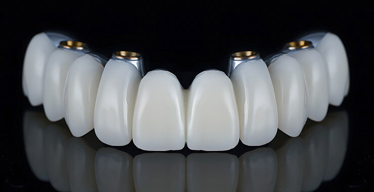 Full arch dental implant prothesis