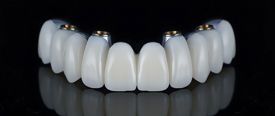 Full arch dental implant prothesis