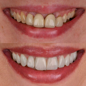 Implant Dentaire en Turquie