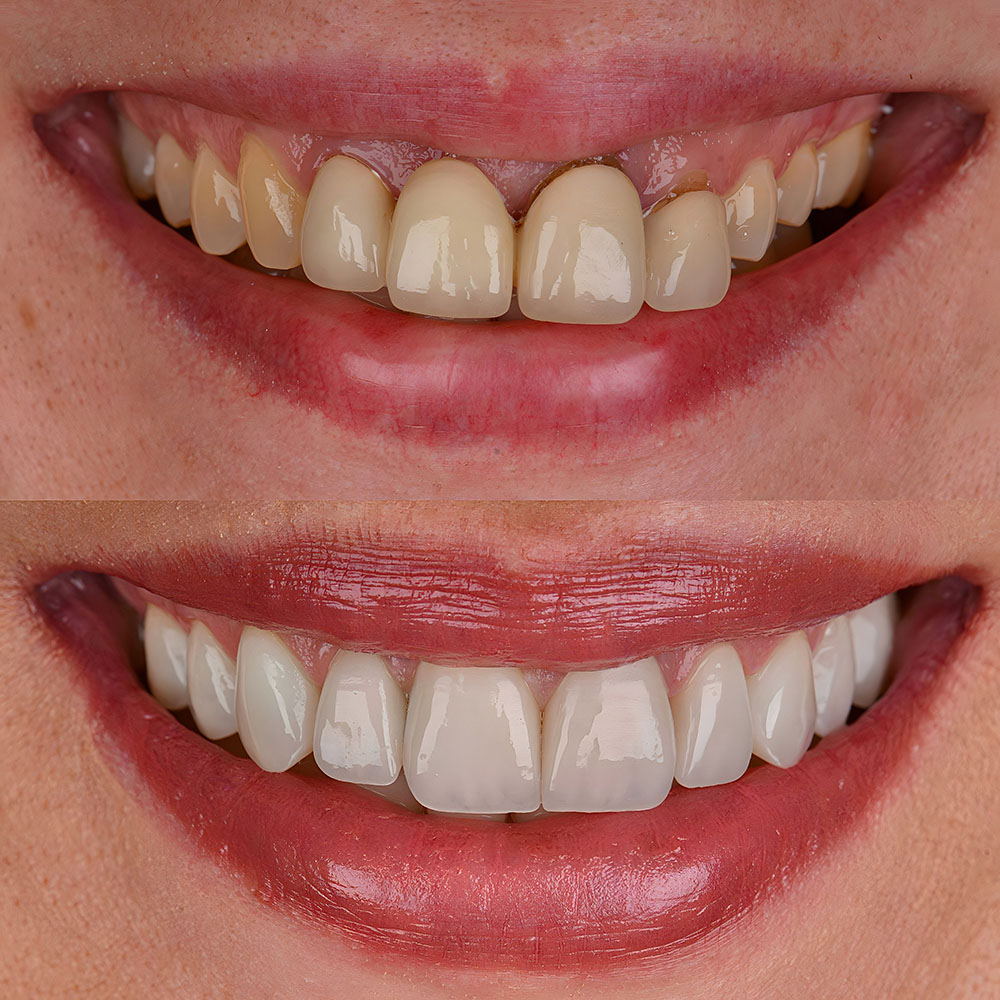 Implant Dentaire en Turquie Zircone