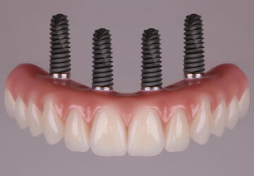 Implant Dentaire en Turquie: Une Solution de Qualité pour Votre Sourire