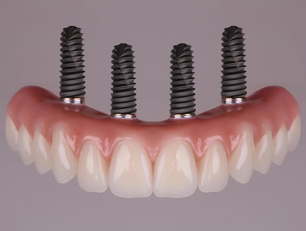 Implant Dentaire en Turquie: Une Solution de Qualité pour Votre Sourire