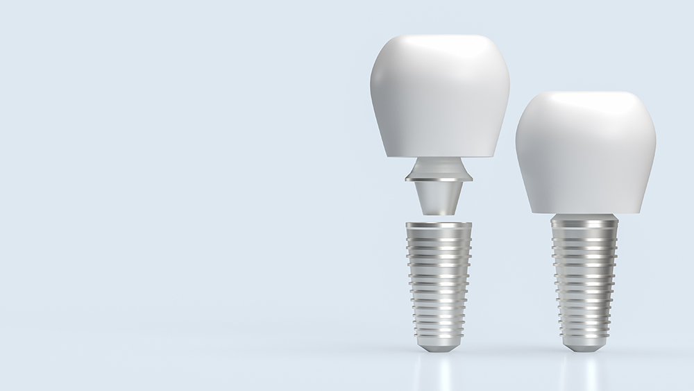 Dental Implants Titanium