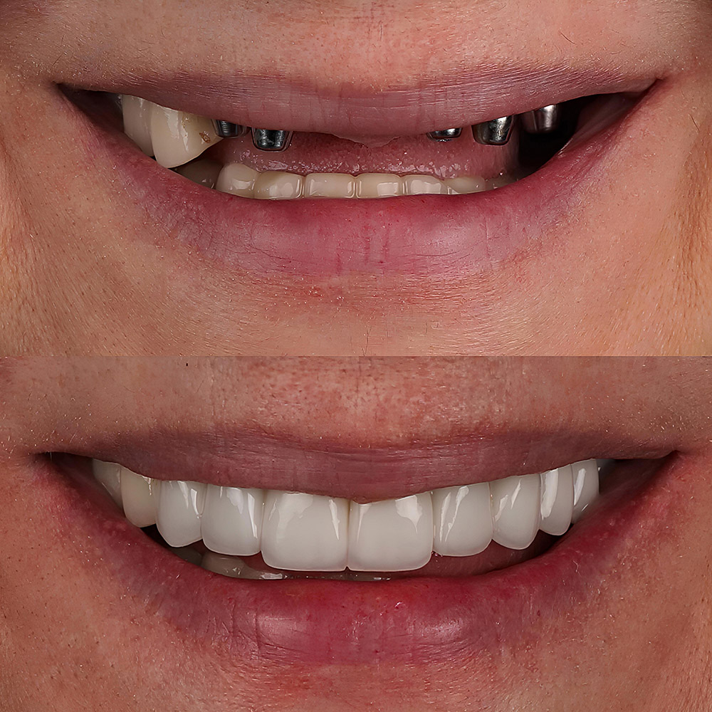 Dental Implants for Missing Teeth