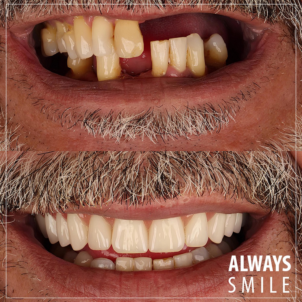 Tooth Replacement with Dental Implants