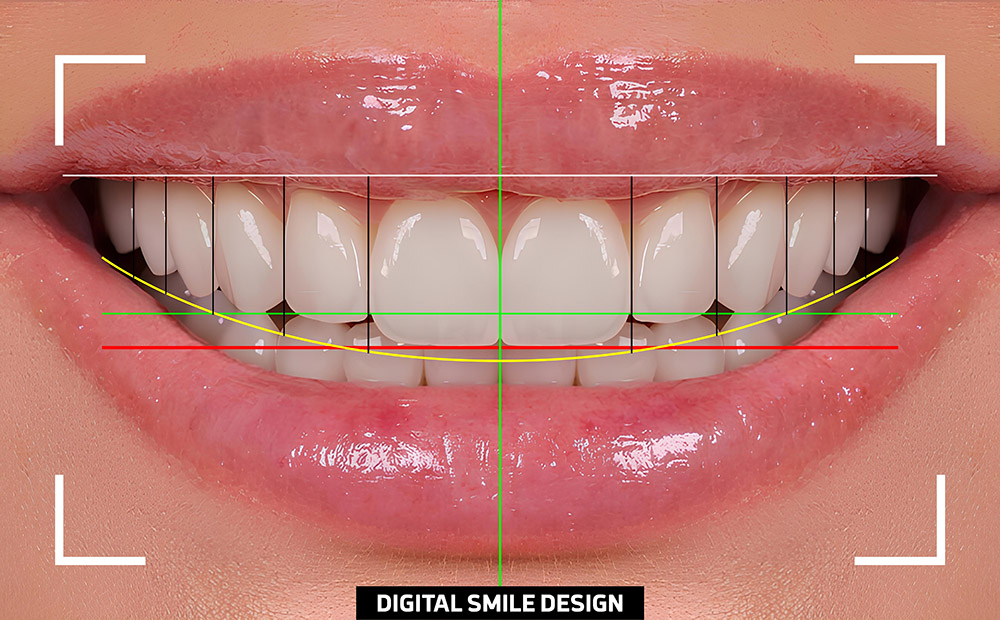 Turkey Teeth Digital Smile