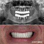 all on 4 dental implant