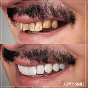 emax porcelain veneers for man