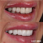 emax porcelain crowns