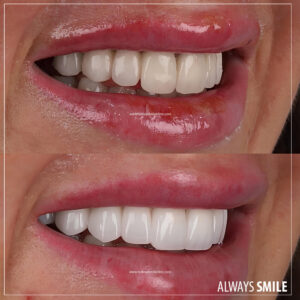 emax porcelain crowns