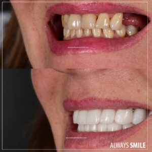 hollywood smile gallery