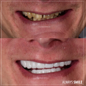 Zirconium crowns for man