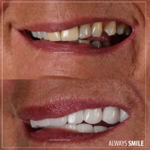 smile makeover for woman