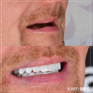 Zirconium crown whitest