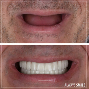 Full mouth dental implants