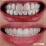 old crown remove and porcelain crowns