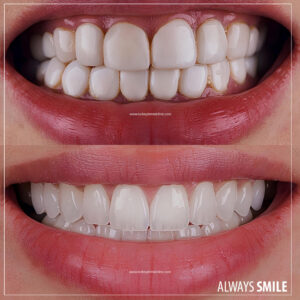 old crown remove and porcelain crowns