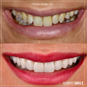 emax veneers