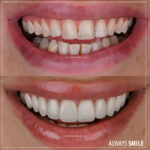 smile design emax porcelain veneers