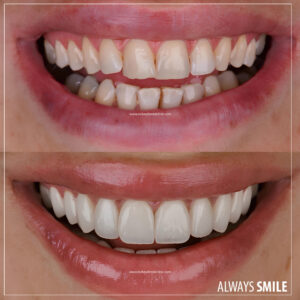smile design emax porcelain veneers