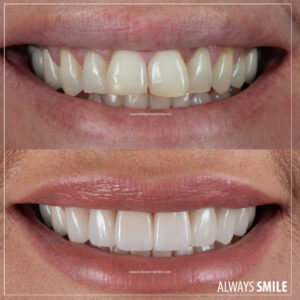 porcelain veneers in turkey