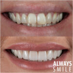 Dental Veneers in Turkey6