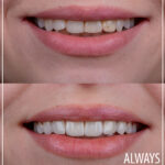 Before and After of perfect smile 4