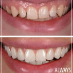 Before and After of perfect smile 2