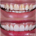 Before and After of perfect smile 1