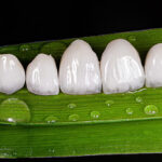 Perfect Smile with Veneers
