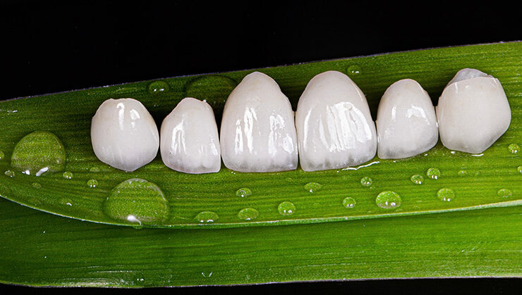 Perfect Smile with Veneers