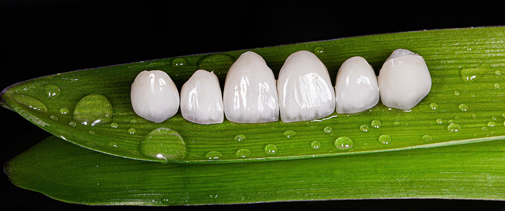 Perfect Smile with Veneers
